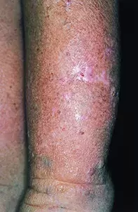 Fig 1. Pretibial skin