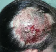Fig 1. Alopecia Fig 1. Alopecia