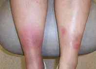 Fig. Leg lesions. Fig. Leg lesions.