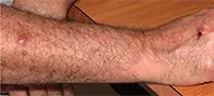 Fig 2. Sporotrichosis. Fig 2. Sporotrichosis.