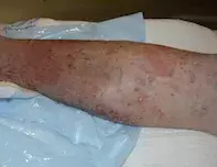 Tinea corporis Tinea corporis