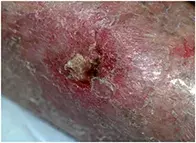 Fig 1. Nonhealing lesion. Fig 1. Nonhealing lesion.