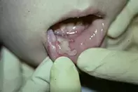 Fig. Mouth ulcer. Fig. Mouth ulcer.