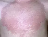 Rash. Rash.