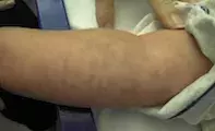 Urticaria. Urticaria.