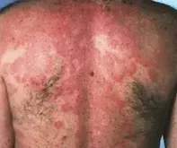 Urticaria. Urticaria.