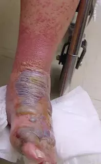 Blistering eruption. Blistering eruption.