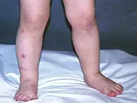 Fig. Itchy nodules. Fig. Itchy nodules.