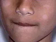 Fig. Hypopigmentation. Fig. Hypopigmentation.
