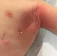 Fig 1. Skin eruption. Fig 1. Skin eruption.