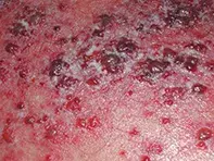 Fig 3. Viral exanthem. Fig 3. Viral exanthem.