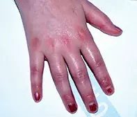 Fig 5. Kawasaki disease. Fig 5. Kawasaki disease.