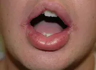 Fig. Swollen lips. Fig. Swollen lips.