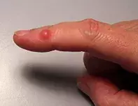 Fig 1. Red nodule Fig 1. Red nodule