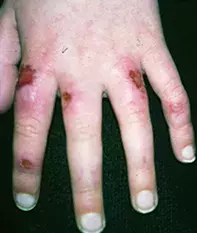 Fig 3. Chilblains Fig 3. Chilblains
