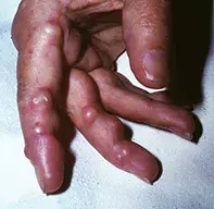 Fig 4. Rheumatoid nodules Fig 4. Rheumatoid nodules