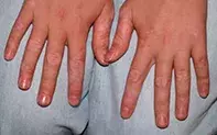 Figure 1. Hand lesions. Figure. Hand lesions.