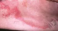 Fig 1. Rash. Fig 1. Rash.