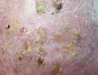 Fig. Scalp lesions Fig. Scalp lesions