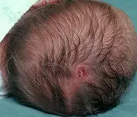 Fig. Scalp lesion