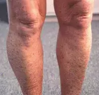 Fig 1. Scaly brown rash. Fig 1. Scaly brown rash.