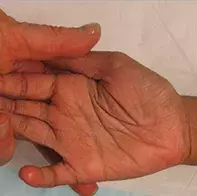 Fig 2. Hyperlinear palm. Fig 2. Hyperlinear palm.