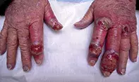 Fig 1. Hand lesions. Fig 1. Hand lesions.