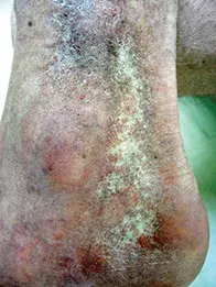 Fig. Atrophic skin. Fig. Atrophic skin.