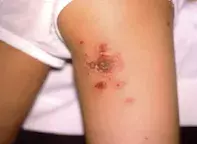 Figure 3. Impetigo. Figure 3. Impetigo.