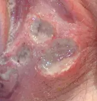 Fig. Ulcers. Fig. Ulcers.