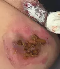 hidradenitis suppurativa hidradenitis suppurativa