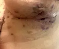 hidradenitis suppurativa hidradenitis suppurativa
