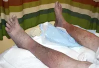 Tinea corporis Tinea corporis