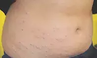 Fig 1a. Vesicular rash. Fig 1a. Vesicular rash.
