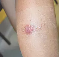 Figure 1b. Lesion on leg. Figure 1b. Lesion on leg.