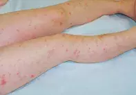 Figure 2. Folliculitis. Figure 2. Folliculitis.
