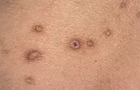 Fig 1. Itchy papules Fig 1. Itchy papules