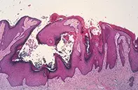 Fig 2. Epidermal hyperplasia Fig 2. Epidermal hyperplasia