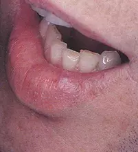 Fig 1. Translucent nodule Fig 1. Translucent nodule