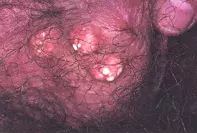 Fig 1. Scrotal nodules