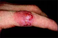 Fig 1. Pustular nodule Fig 1. Pustular nodule