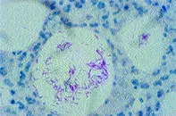 Fig 2. Skin biopsy Fig 2. Skin biopsy