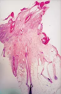 Fig 2. Scalp biopsy