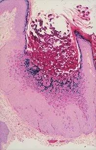 Fig 2. Skin biopsy Fig 2. Skin biopsy