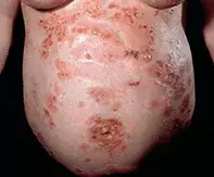 Fig 1. Symmetrical rash