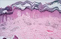 Fig 2. Skin biopsy Fig 2. Skin biopsy