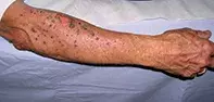 Fig 1. Arm rash Fig 1. Arm rash
