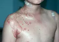 Fig 2. Bullous impetigo Fig 2. Bullous impetigo