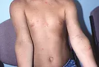 Fig 2. Allergic contact dermatitis Fig 3. Allergic contact dermatitis