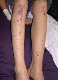 Fig. Leg rash Fig. Leg rash